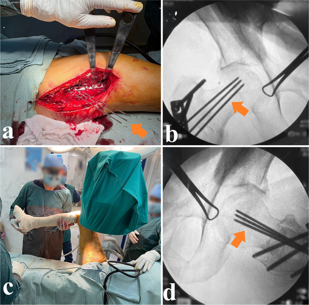 Definitive fracture fixation using dynamic hip screw (DHS) plate. (a) The application of guidewires as an initial step to determine proper DHS lag screw position (orange arrowheads). (b) An anteroposterior fluoroscopic view showing the proper guidewires positioning (orange arrowhead). (c) The position for obtaining a lateral view for guidewires position assessment. (d) A fluoroscopic lateral view showing proper guidewires position (orange arrowhead).