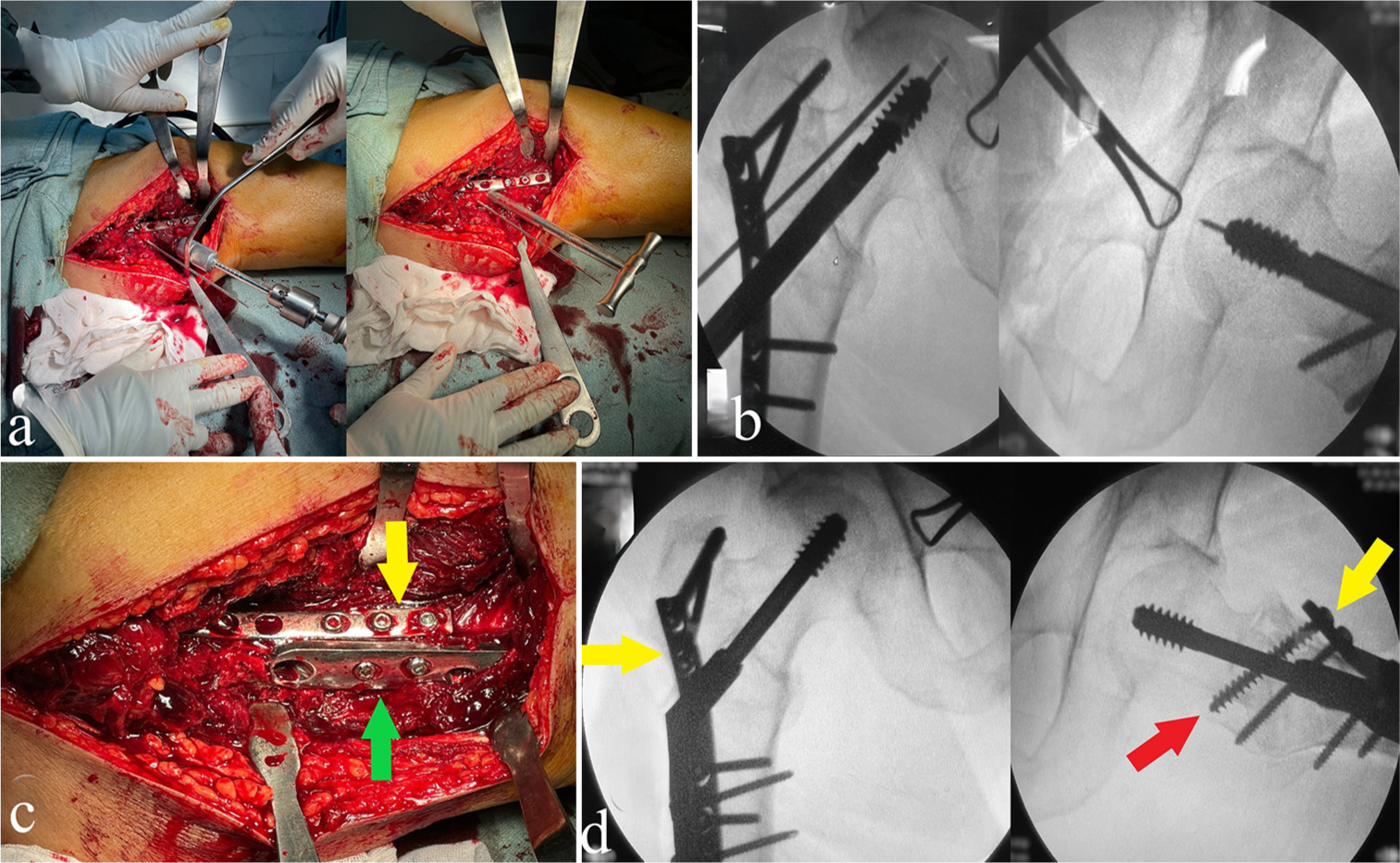 (a) Reaming and application of dynamic hip screw (DHS) lag screw. (b) An anteroposterior (AP) and lateral fluoroscopic views confirming the lag screw proper position within the femoral neck and head. (c) Definitive plate application and fixation, showing the relative position of the anterolateral narrow DCP (yellow arrowhead) to the DHS side plate (green arrowhead). (d) Final AP and lateral fluoroscopic views after definitive fixation showing the proper plates position (yellow arrowhead), fracture reduction, and optimum fixation (the red arrow indicates changing the proximal screw in the anterolateral plate from a cortical 4.5 to a fully threaded cancellous 6.5 screw).