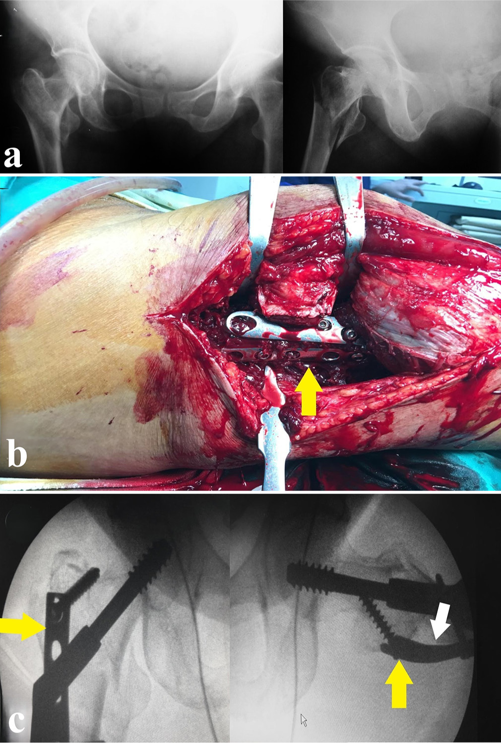 A female patient, 75 years old, presented with an unstable intertrochanteric fracture (classified as AO/31A2). (a) Preoperative anteroposterior (AP) and lateral views. (b) An intraoperative image showing the application and position of a posterolateral narrow DCP (yellow arrowhead). (c) Intraoperative AP and lateral fluoroscopic views show the position of the dynamic hip screw and the posterolateral narrow DCP (yellow arrowhead); furthermore, the white arrowhead indicates the location of narrow DCP contouring to accommodate this specific anatomical location configuration. DCP: Dynamic compression plate.