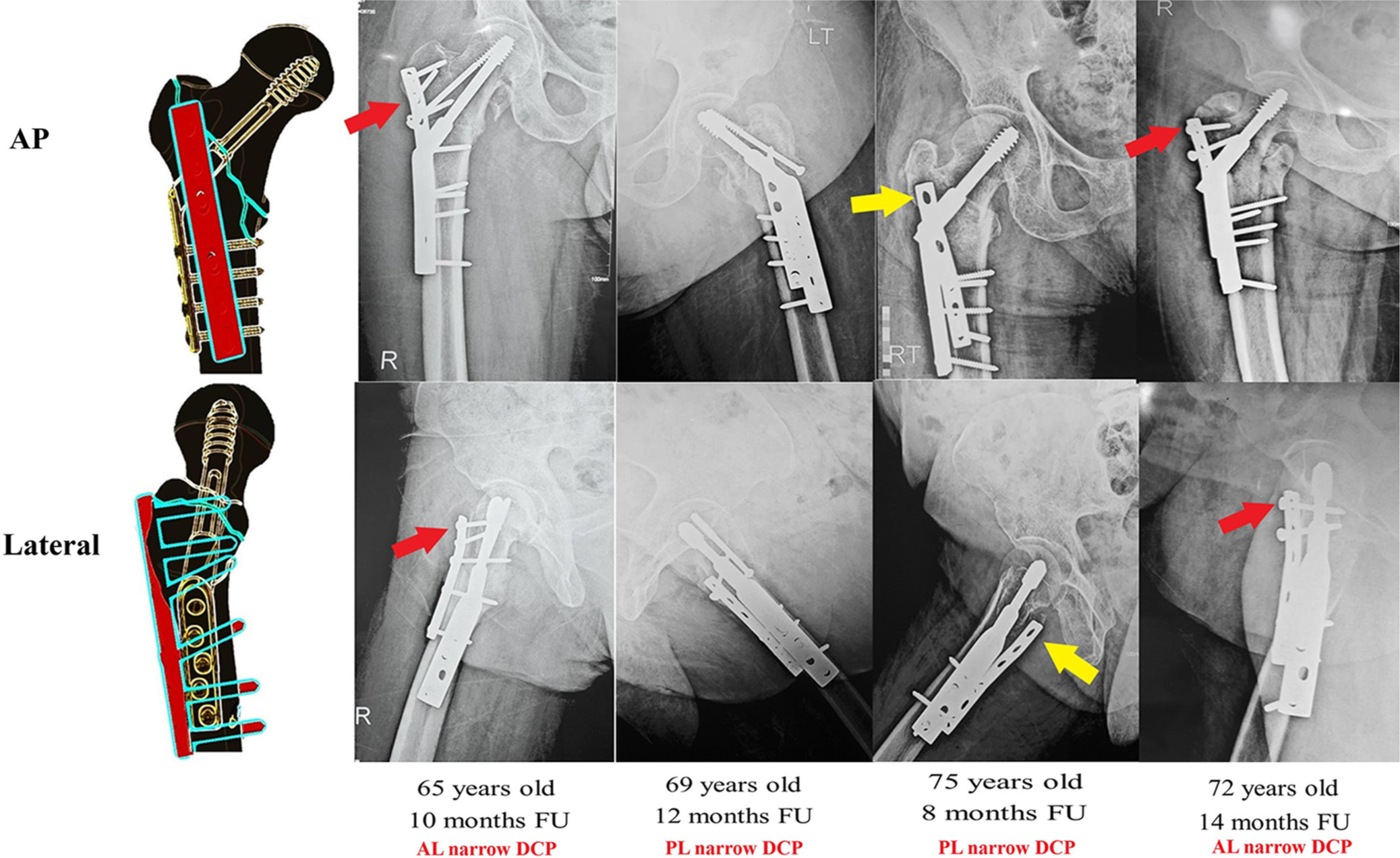 A schematic diagram and follow-up radiographs of previous cases showing the relation of the dynamic hip screw side plate to the anterolateral narrow DCP plate; furthermore, it shows the optional anterolateral plate proximal fixation (indicated by red arrows) or leaving it without screws (indicated by yellow arrows). AL: Anterolateral, PL: Posterolateral, FU: Follow-up, DCP: Dynamic compression plate.