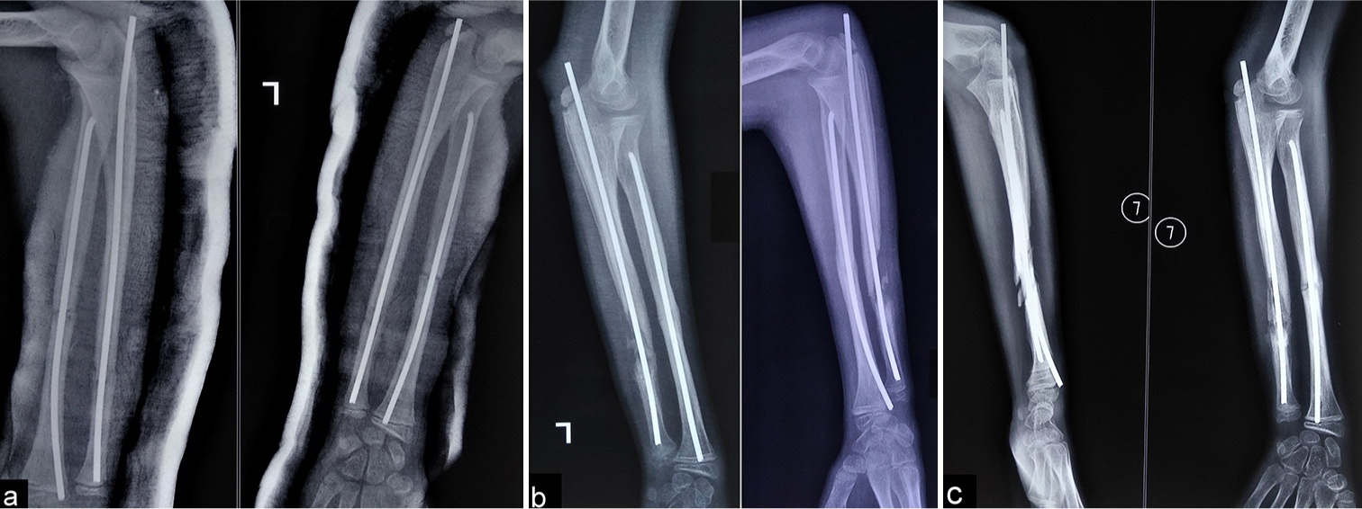 (a) The radiograph shows well-reduced fracture fixation with flexible nails in the radius and ulna. (b) Cortical irregularity and localized infection were noted over the ulna. (c) The infection was managed with regular dressing and implant retention.