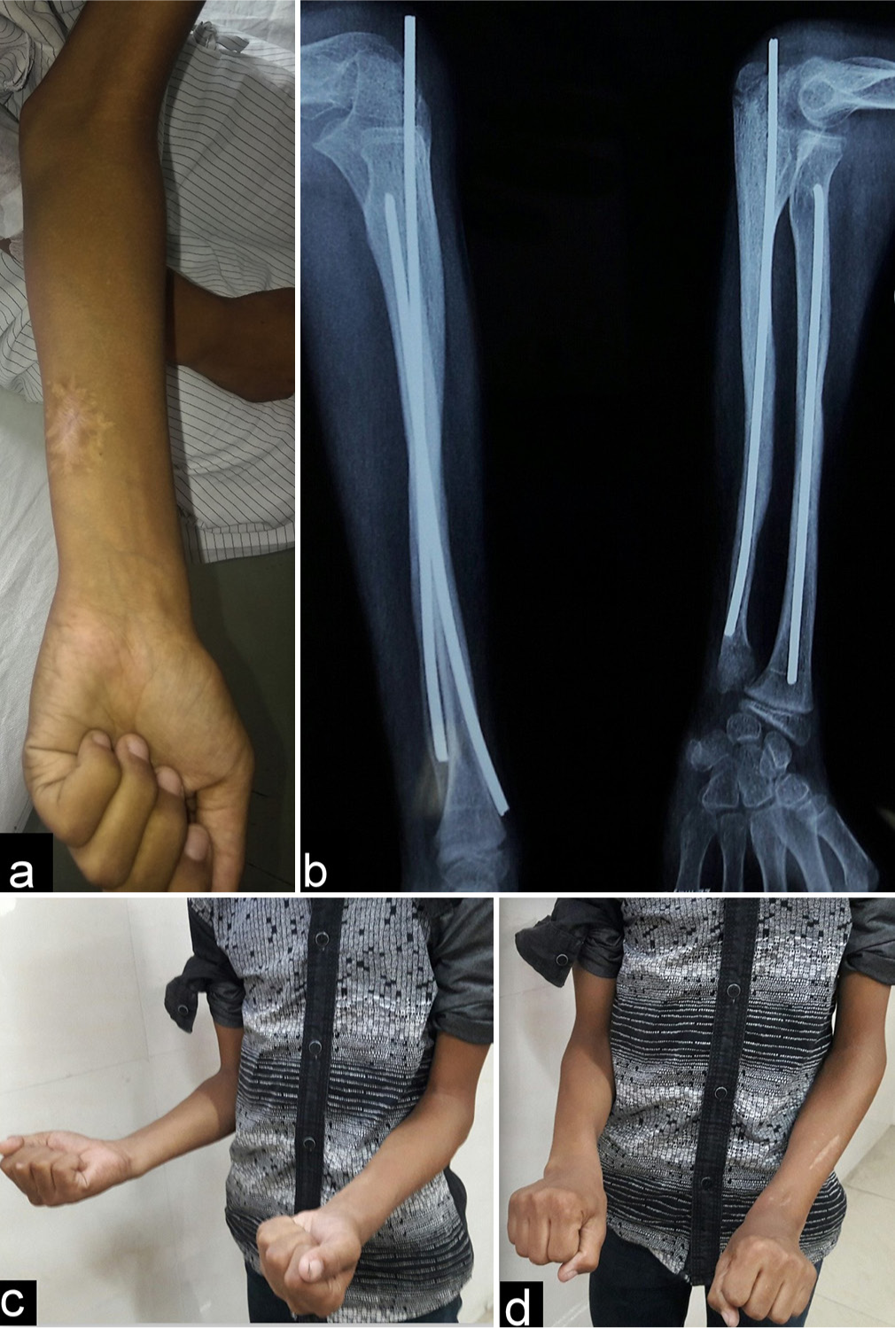 (a and b) The final clinical image shows the healed wound, along with a completely united fracture. (c and d) The full regain of elbow and pronation-supination movement is noted in the final follow-up.