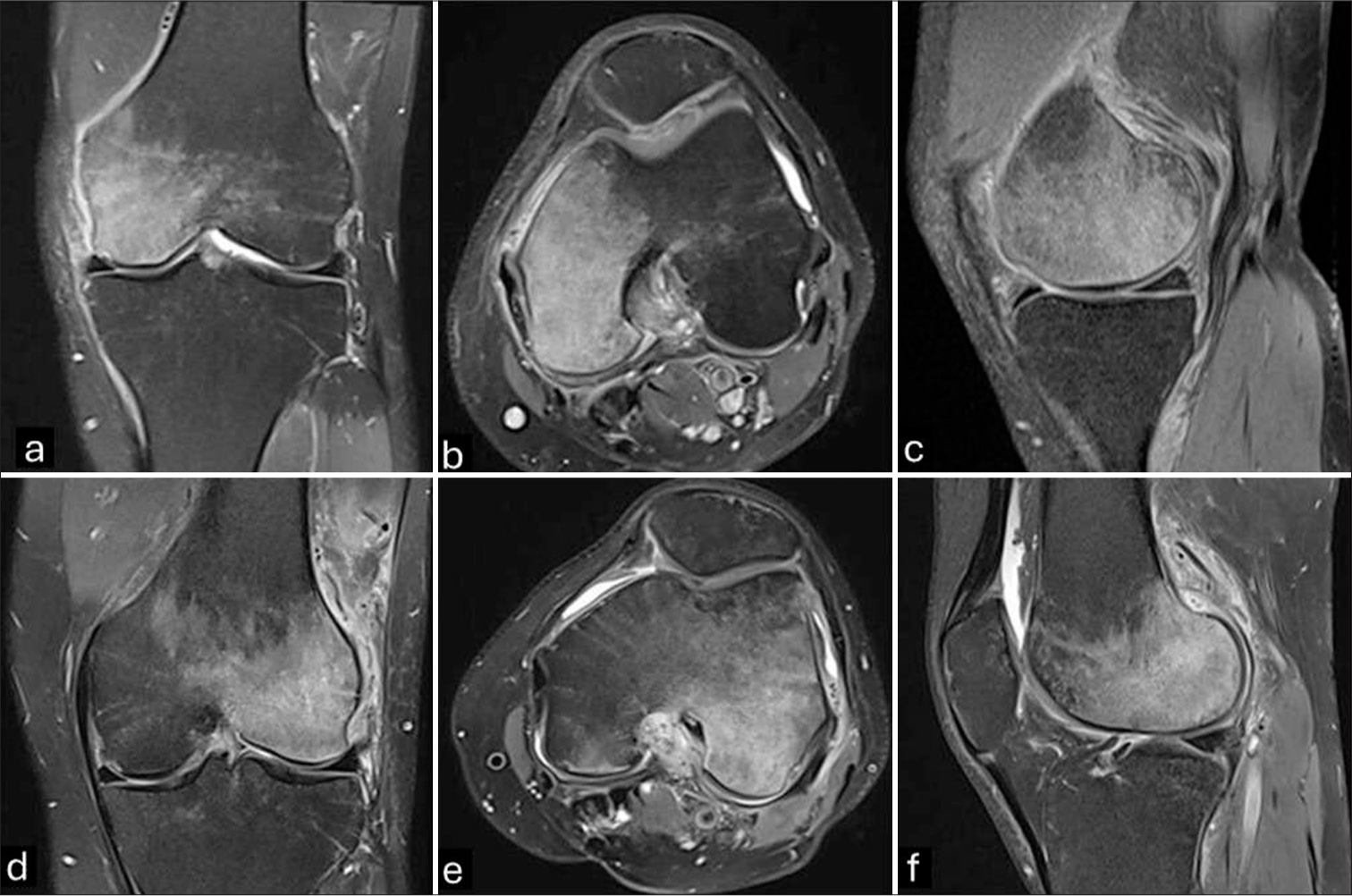 MRI of the left knee. Initial MRI of the left knee. Bone marrow edema signal involving the medial femoral condyle, without subchondral bone plate or cartilage abnormalities. Pericapsular edema and synovitis are noted. (a) Coronal PD FS. (b) Axial PD FS. (c) Sagittal PD FS. (d) Three-month follow-up MRI of the left knee. There is complete resolution of the BME signal in the medial femoral condyle with extensive bone marrow edema involving the lateral counterpart. There is capsulitis, synovitis, and soft-tissue edema. Coronal PD FS. (e) Axial PD FS. (f) Sagittal PD FS. (MRI: Magnetic resonance imaging, PD: Proton density, FS: Fat-saturated, BME: Bone marrow edema).