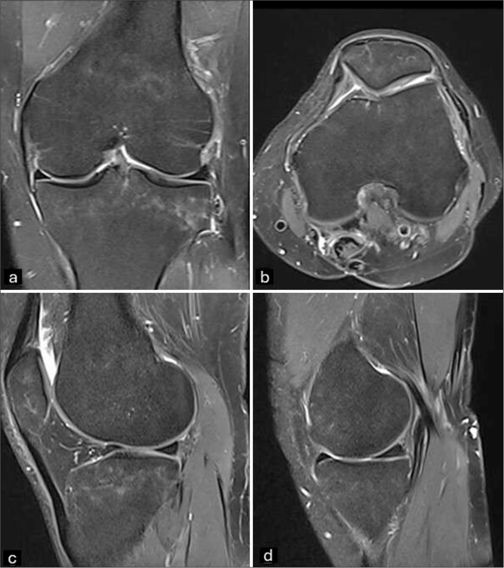 Last magnetic resonance imaging of left knee. A three-month follow-up. (a and b) Complete resolution of the bone marrow edema signal is noted. (c and d) A residual irregularity and flattening of the subchondral bone plate is seen at the weight-bearing area of both lateral and especially medial femoral condyles.