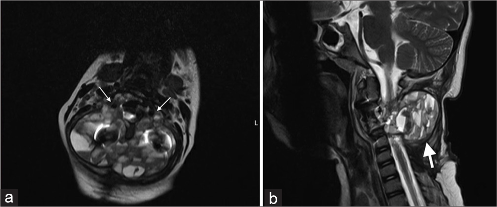 (a) Axial and (b) Sagittal magnetic resonance imaging on presentation shows the lesion at C3, arrows showing the tumor encasing the vertebral artery bilaterally.