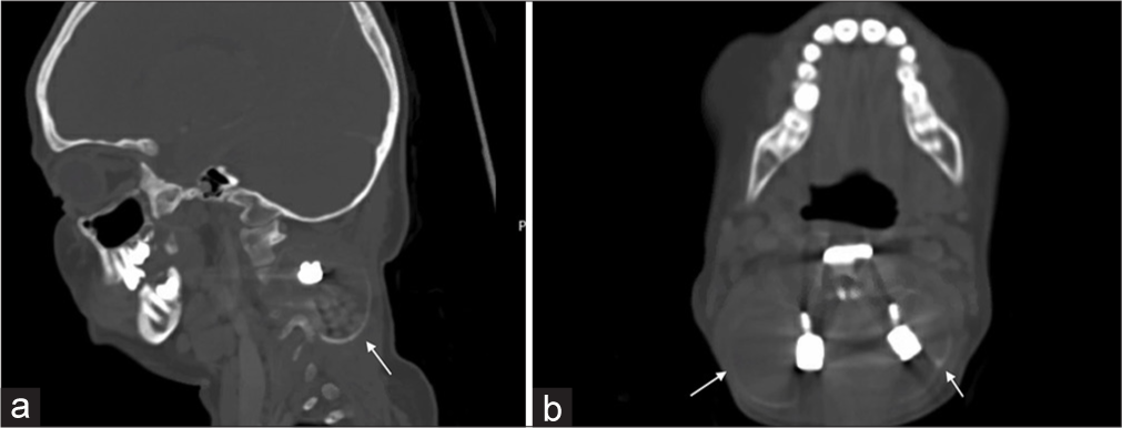 (a) Sagittal and (b) Axial computed tomography on presentation shows the extent of the lesion (arrows) with stable implants and a mild kyphotic deformity in the cervical spine.