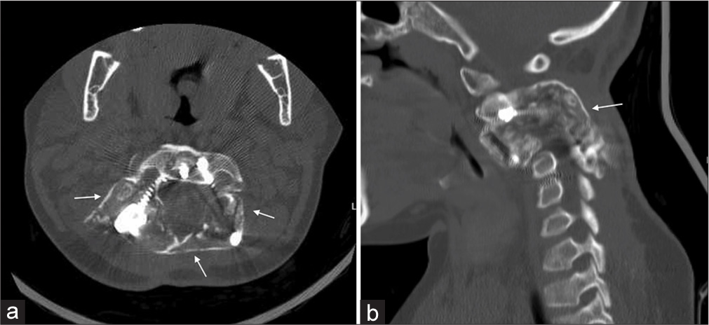 Follow-up (a) Axial and (b) Sagittal computed tomography with arrows showing complete calcification and fusion of the lesion.