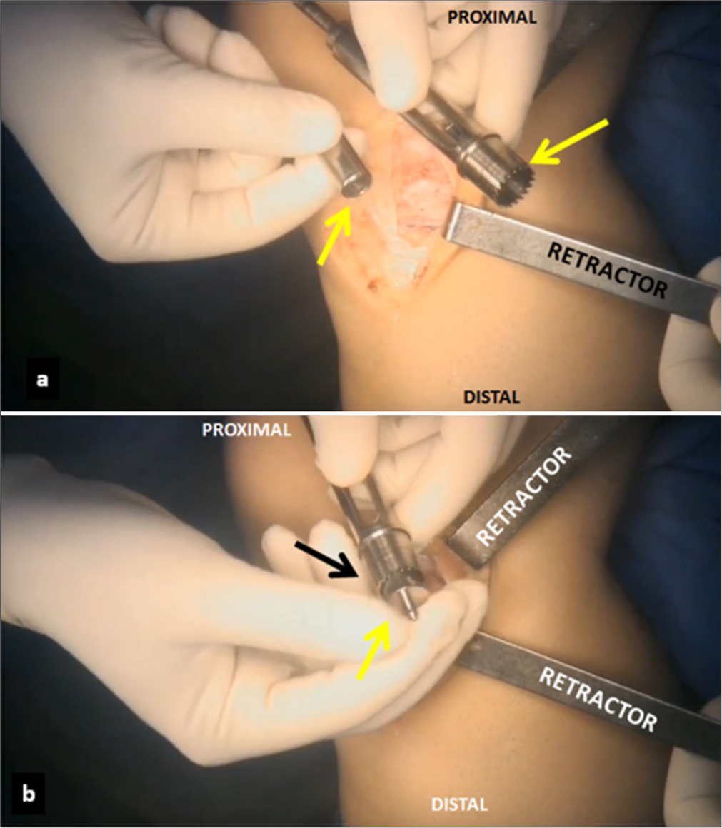 (a) A specially designed cannulated trephine (yellow arrows) is used to remove a 1.2 cm wide bone plug from the right knee. (b) A cylinder with the small peg (yellow arrow) is inserted into the unicortical hole (black arrow). The trephine is placed underneath the medial collateral ligament, and the tibial cortex is perforated perpendicular to the tibial axis.