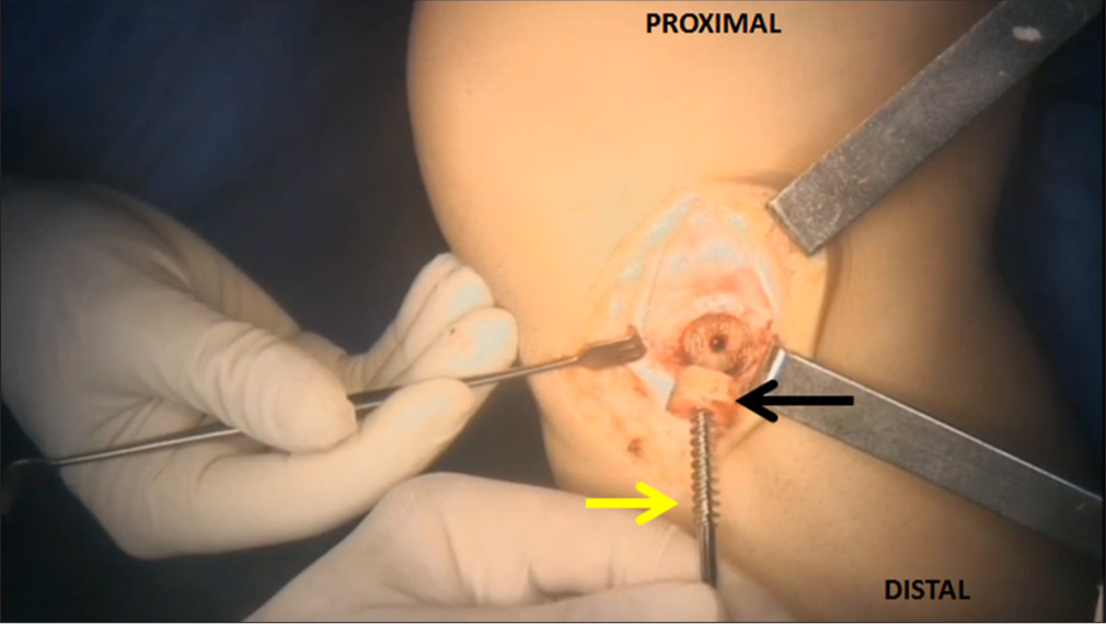 The 1.2 cm wide bony plug (black arrow) is removed from the proximal tibia using a cortical screw (yellow arrow).