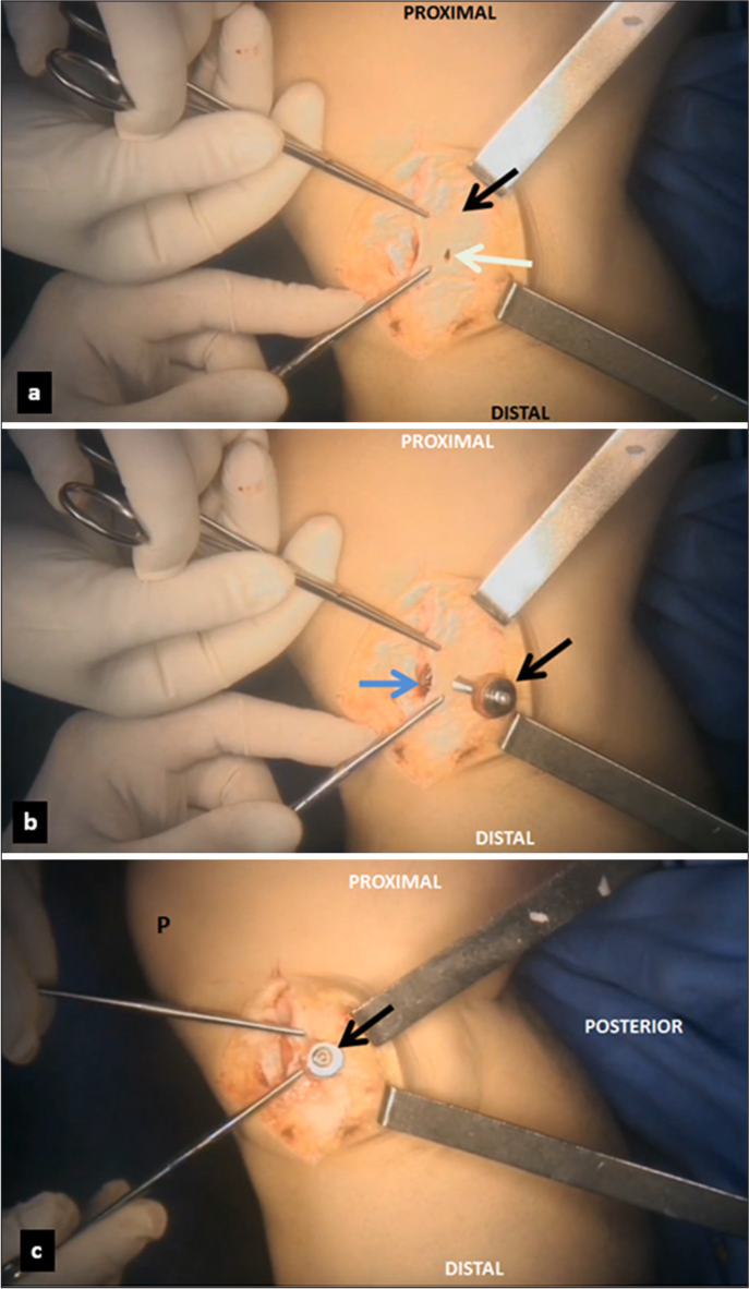 (a) After the removal of the bone plug, a small incision (white arrow) is made 1 cm medially from the initial incision (black arrow). (b) The medial collateral ligament is re-tensioned with Kocher clamps. A 4.5 mm cortical screw (black arrow) is inserted through the bone plug into the created defect (blue arrow). (c) The final view shows successfully implemented cortical screw and washer (black arrow). P: Patella.