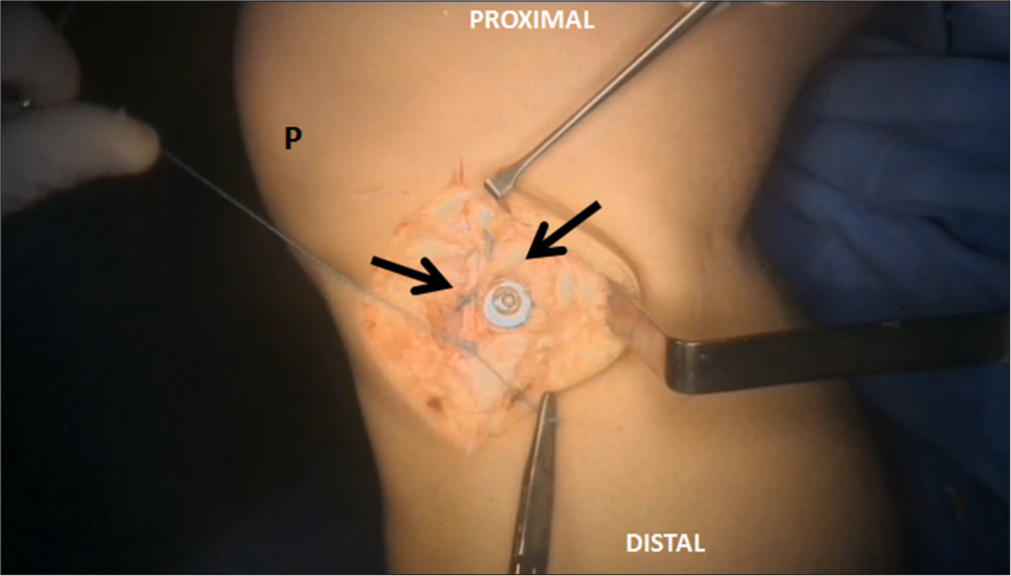 Once the fixation of the medial collateral ligament (black arrows) is complete, the 5 cm incision is closed using absorbable sutures. P: Patella.
