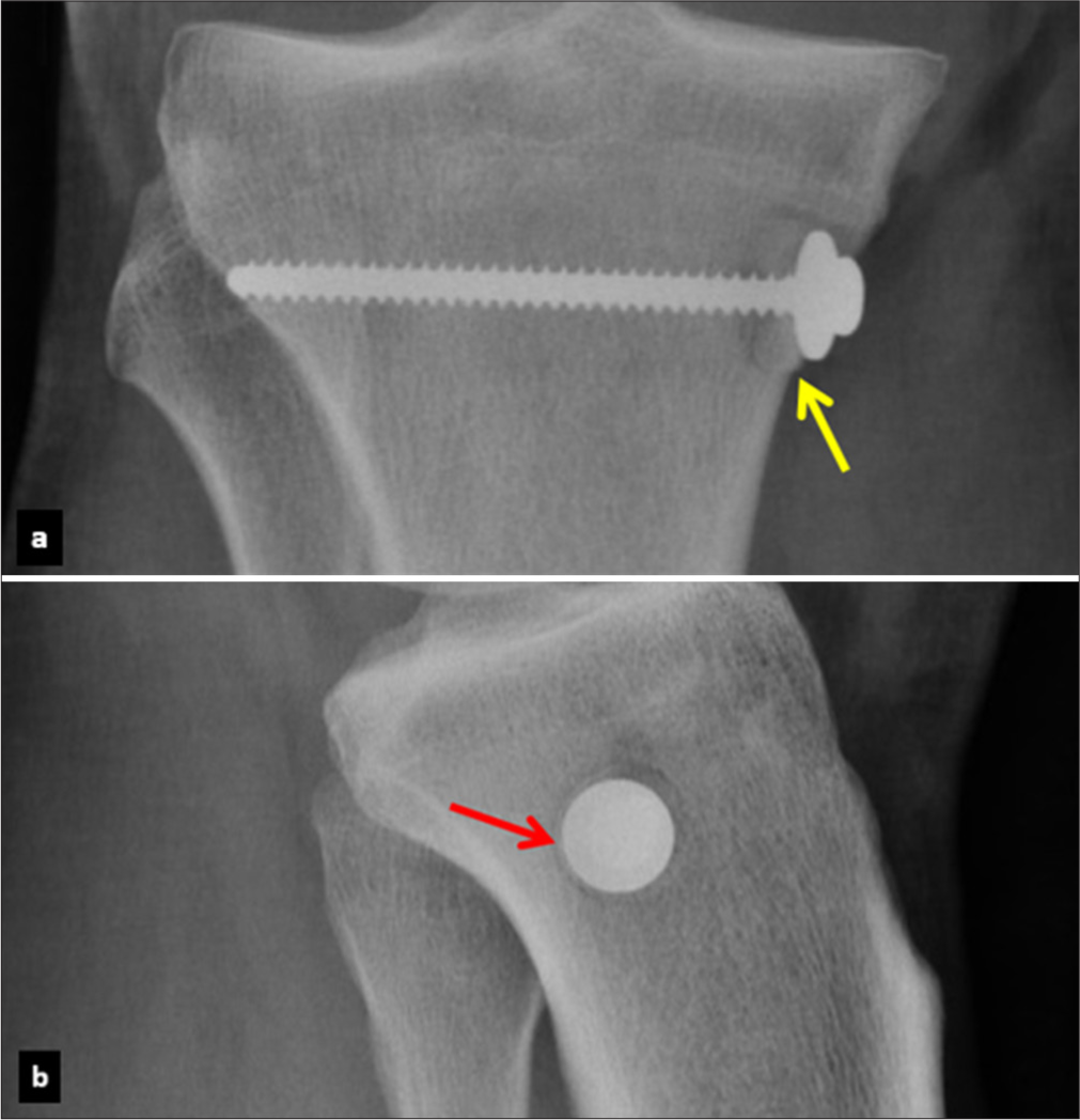Radiographic images in the (a) anteroposterior and (b) lateral views of the right knee, demonstrating successful fixation of the bone plug (yellow arrow). Note the perpendicular insertion of the screw (red arrow).