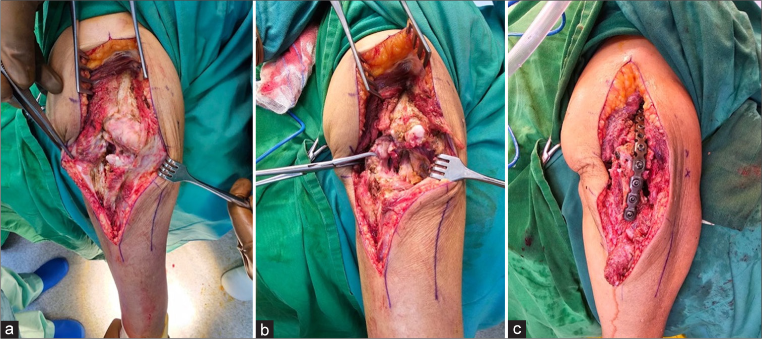 (a) Intraoperative photograph during arthrodesis procedure showing the posterior approach to the right elbow. The joint is exposed with visible loose cartilaginous bodies and synovial proliferation consistent with advanced synovial chondromatosis. (b) Intraoperative photograph during arthrodesis procedure of the right elbow following complete excision of loose bodies and hypertrophic synovium. The joint space is clearly visible and prepared for arthrodesis following tumor clearance in synovial chondromatosis. (c) Final intraoperative image demonstrating completed elbow arthrodesis using plate and screw fixation after tumor excision for advanced synovial chondromatosis. The joint was fused in 90° of flexion to provide structural stability and pain relief.