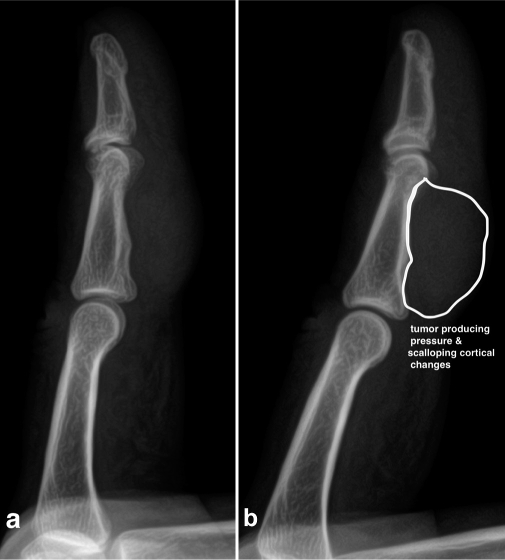 (a, b) The radiograph of the finger shows a large tumor exerting pressure (indentation) on the surrounding cortex, indicating cortical erosion due to its invasive and progressive nature.