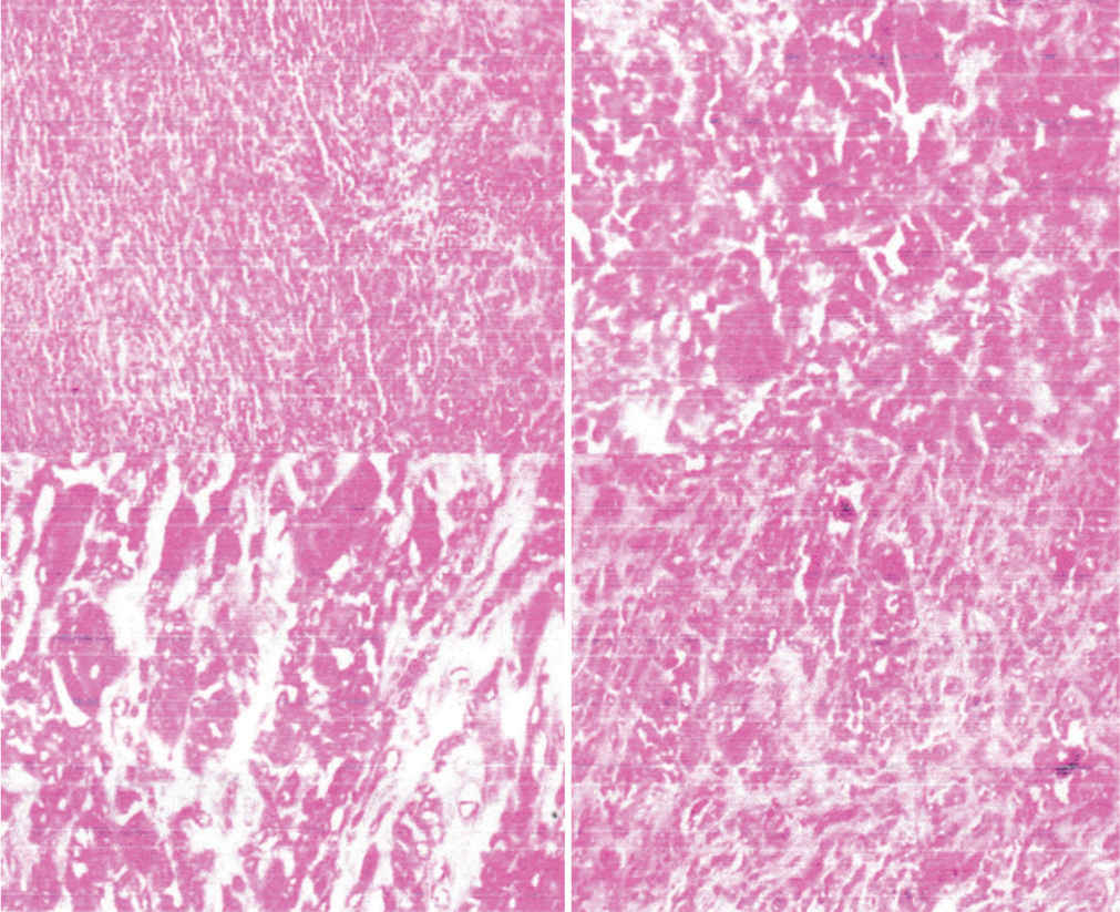 The histopathological sections reveal a circumscribed proliferation of benign tenosynovial cells, along with collagen deposition, small giant cells, and foamy macrophages. These findings are consistent with a benign giant cell tumor of the tendon sheath. Notably, there are no histological features indicative of neurofibroma, lipoma, or malignancy.