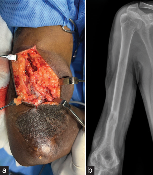 (a, b) The gap pattern of nerve injury is seen in the humerus fractures.