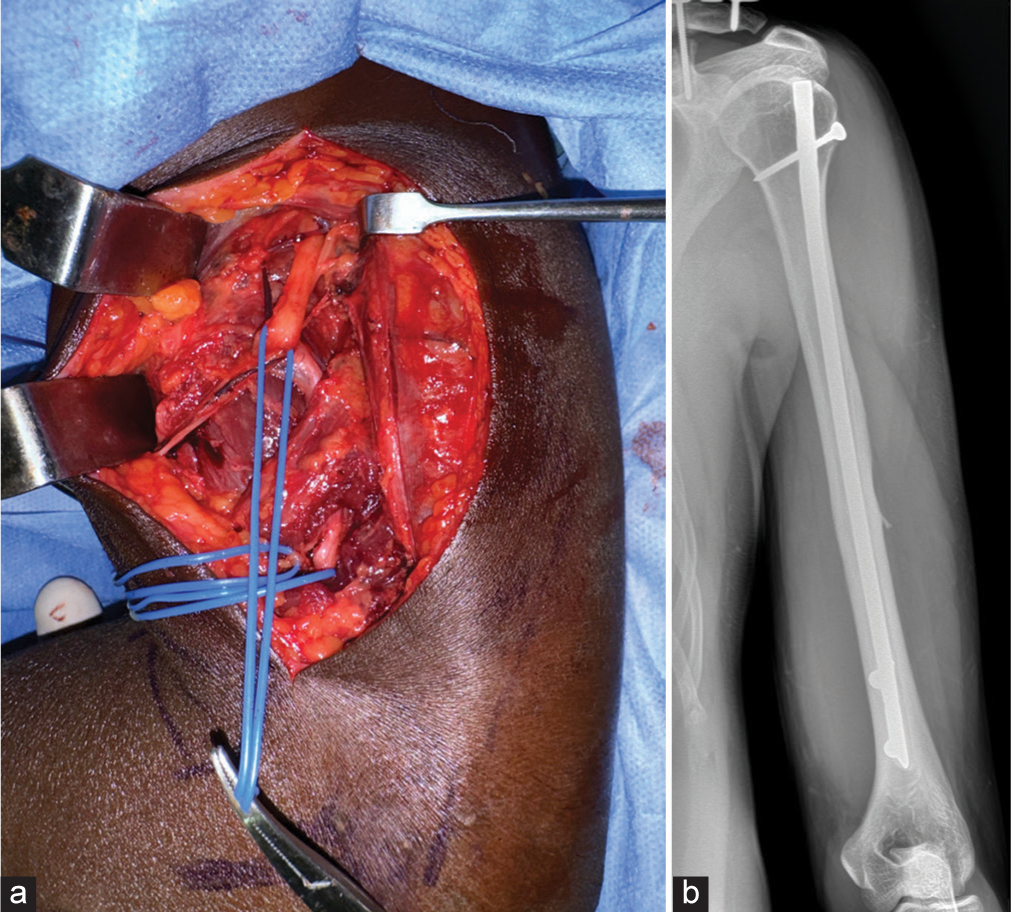 (a, b) The crushed pattern of nerve injury seen in the humerus fractures has few fascicles in continuity.