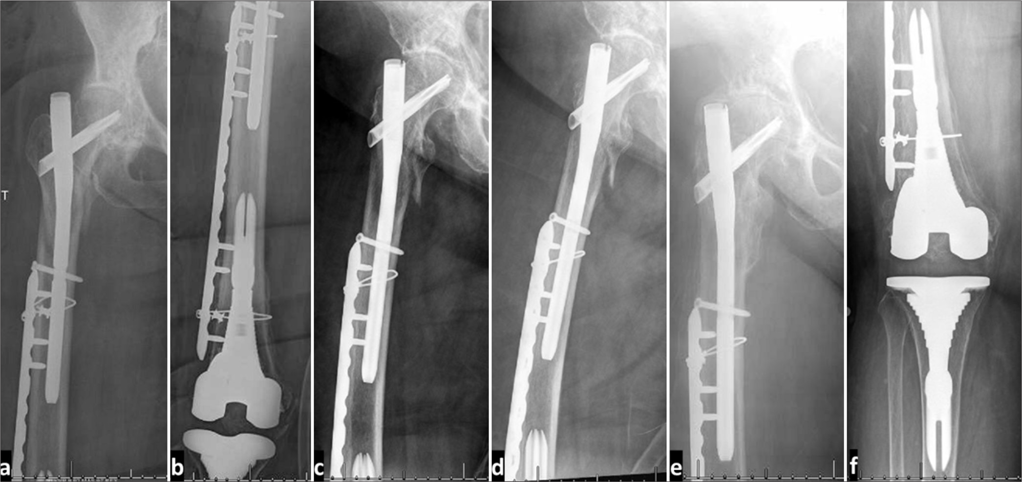 (a and b) Immediate post-operative radiographs after open reduction and internal fixation using intermediate length proximal femoral nail with bridging plate for a 73-year-old female who sustained a low intertrochanteric fracture (AO/OTA 31A2.3) involving the proximal femoral lateral cortex, in the presence of a stemmed revision total knee arthroplasty that was inserted 1 month before. (c and d) 2-week follow-up radiographs showing maintained reduction. (e and f) 3-year follow-up radiographs showing fracture consolidation and maintained reduction.