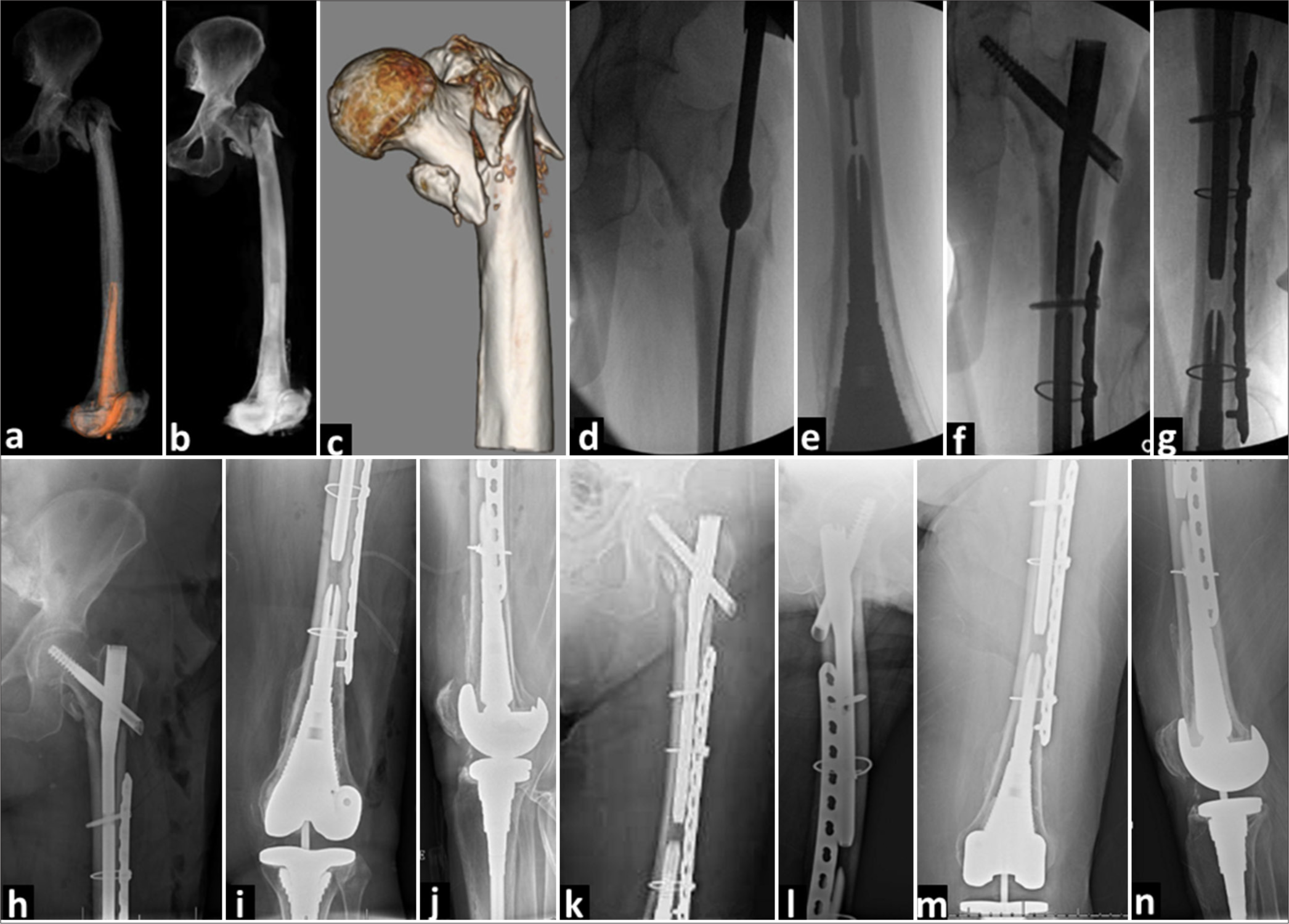 (a-c) Plain radiographs of an 84-year-old male who sustained an intertrochanteric femoral fracture due to a fall. (d-g) Intraoperative C arm radiograph showing reduction with bridging fixation. The purpose of bridge plating is just to dissipate the stress riser at the end of the two opposing two intramedullary implants and not for fracture fixation. Consequently, the surgeon felt that plate fixation on either side of the nail could be sufficiently achieved with a single screw and cerclage wire. (h-j) Immediate post-operative radiographs. (k-n): 3-month follow-up anteroposterior and lateral radiograph showing fracture healing and stable fixation.