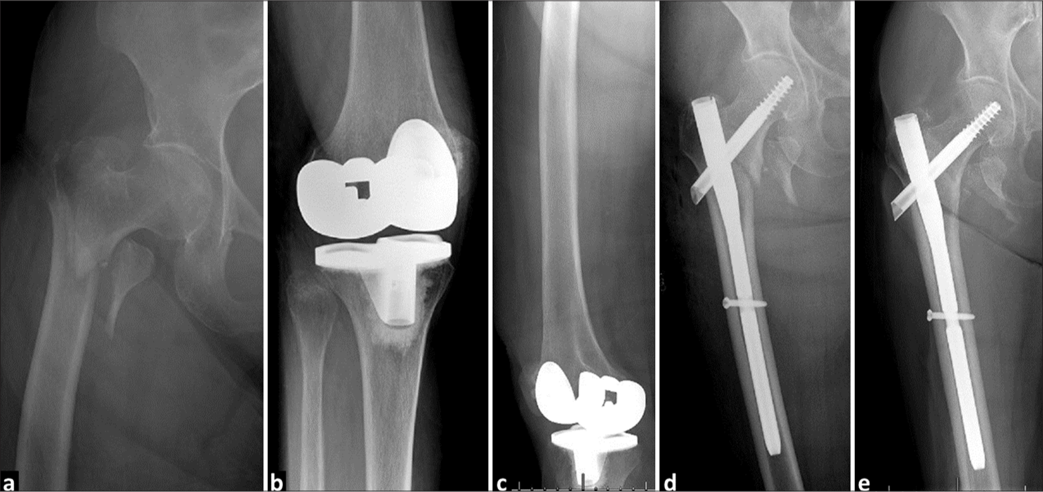 (a) Plain hip radiograph of a 90-year-old female presented with AO/OTA 31A2.3 trochanteric fracture. (b and c) The patient also had a loose, malrotated total knee arthroplasty (TKA). (d) Immediate post-operative hip radiograph and (e) 8-week post-operative plain hip radiograph showing fracture healing after insertion of intermediate-length cephalomedullary nails (ILCMN). The surgeon opted for intermediate-length cephalomedullary nails rather than long cephalomedullary nails to avoid any potential interference with the TKA, which would potentially require revision.