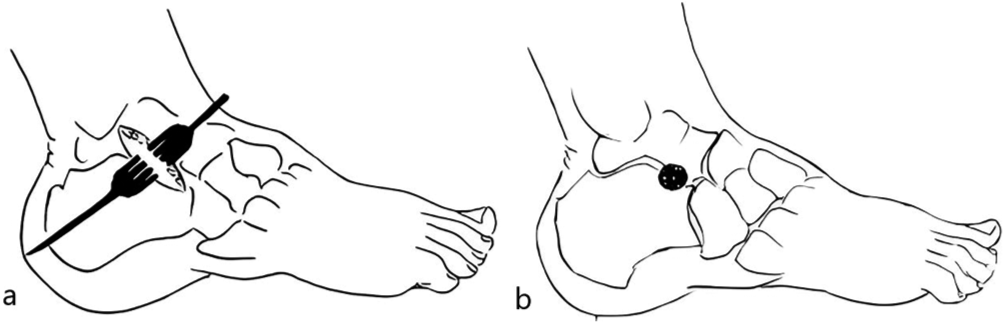 (a) Surgical technique. Approximately 2 cm incision centered on the sinus tarsi in the line passing between the fibular malleolus and the cuboid, (b) A lateral view of the screw inserted in the sinus tarsi.