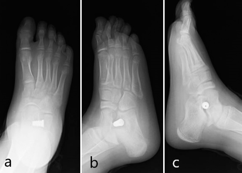 Post-operative radiographs: (a) AP view, (b) Oblique view, (c) Lateral view.