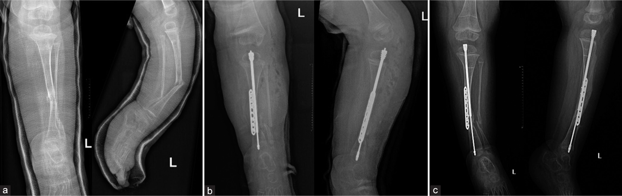 Radiological images of a patient with congenital pseudoarthrosis of the tibia who was treated with Fassier-Duval nail and tibial plating. (a) shows a pre-operative radiograph, (b) was taken 1 day postoperatively, and (c) shows complete union after 4 months from surgery.