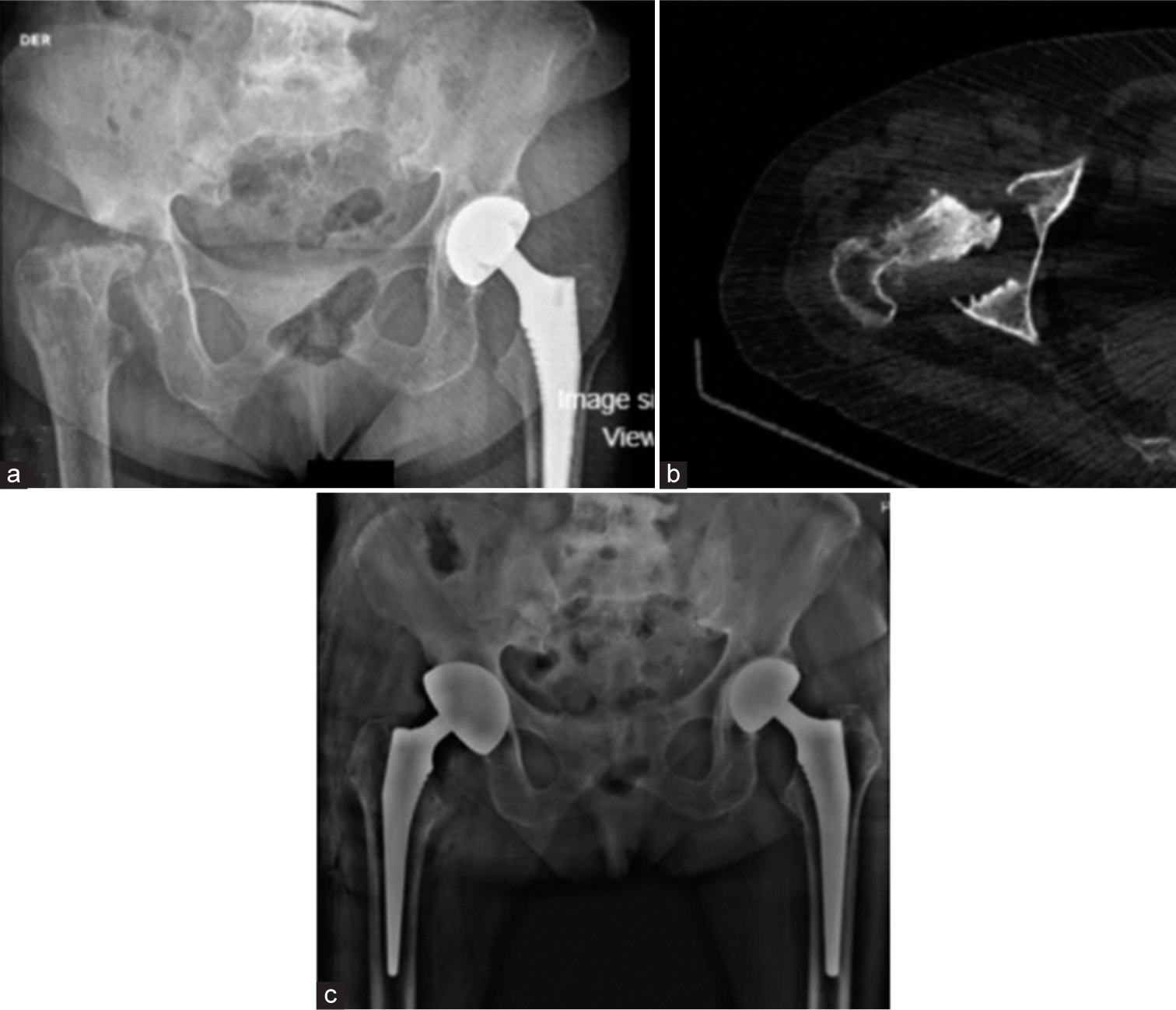 (a) Bilateral hip radiograph, 1 year postoperatively: Left hip prosthesis without changes, bone resorption changes in the proximal femur head and right supra-acetabular. (b) Computed axial tomography confirming acetabular and femoral head erosion. (c) Post-operative hip radiograph: Uncemented mega acetabular cup and femoral stem.