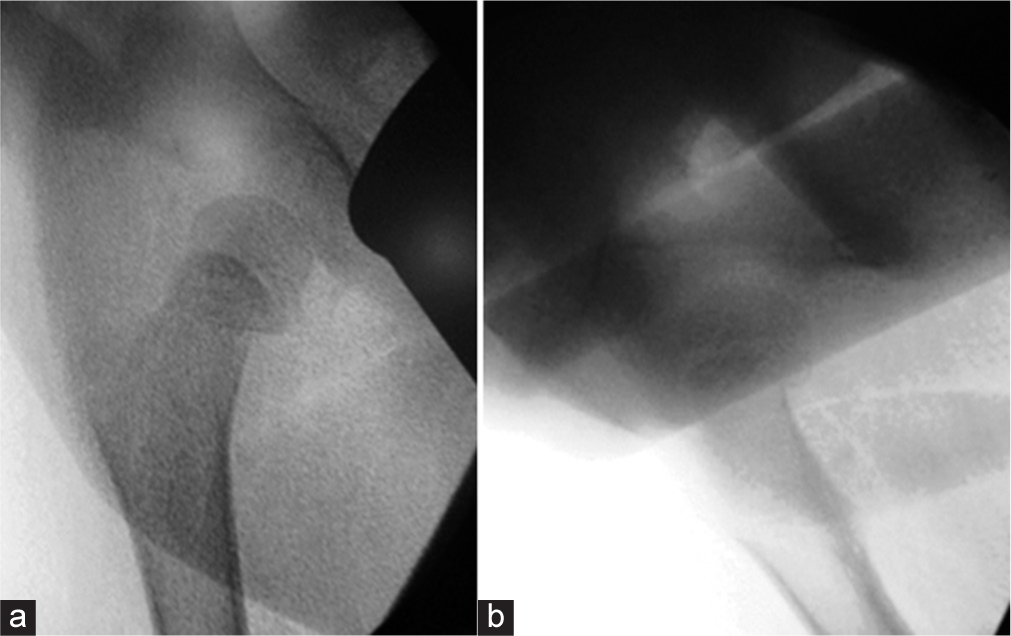 Anatomical reduction in (a) anteroposterior and (b) lateral fluoroscopy images.