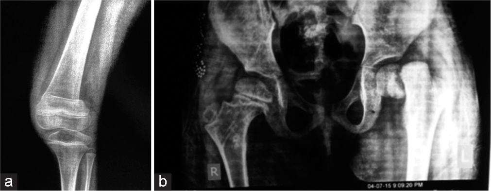 (a) Anteroposterior radiograph showing an old left supracondylar femoral buckle fracture and (b) ipsilateral Delbet type I fracture 3-month post-injury.