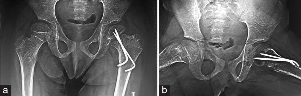 (a) Anteroposterior and (b) frog lateral radiographs of both hips 1 year following surgery on the left and 2.5-year post-surgery on the right, showing the union of the left hip fracture in an anatomical position, with no signs of avascular necrosis bilaterally. Kirschner wires were removed at the time.