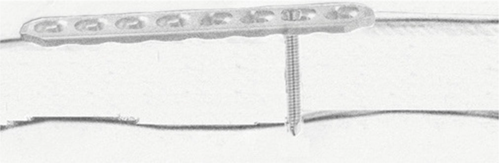 Lateral view of a demonstration of the locking plate on the bone with the jammed locking screw in.