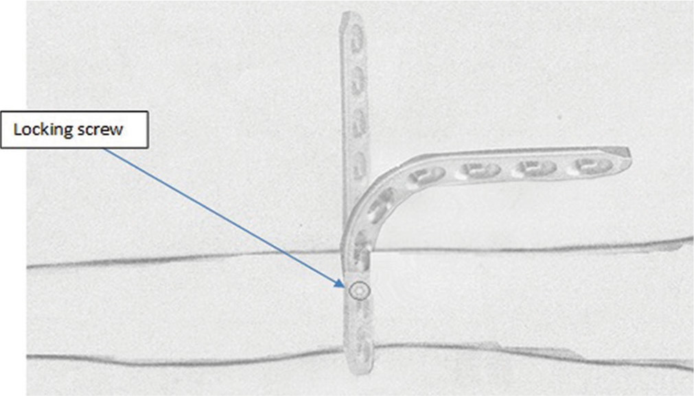 Superior view of a demonstration of the locking plate transition into a bent plate after rotating the plate 90° horizontally with the bone while the jammed locking screw is in.